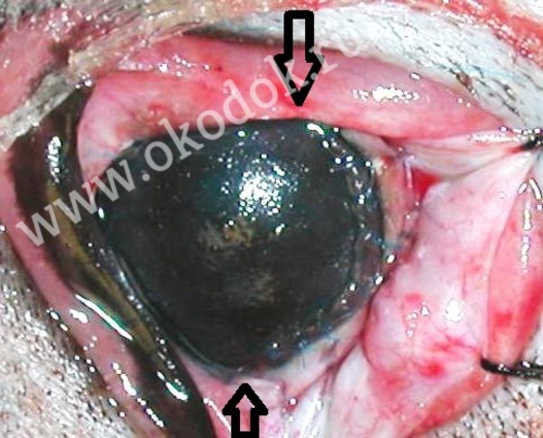 Глаз после удаления фиброваскулярного паннуса